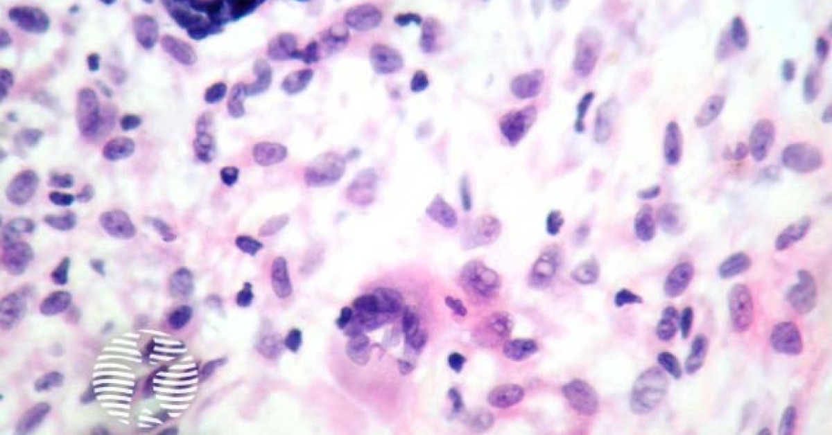 Juvenile xanthogranuloma image