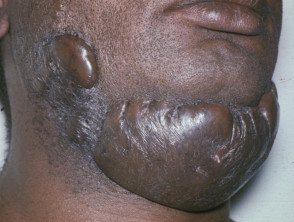 Keloid scar in skin type VI