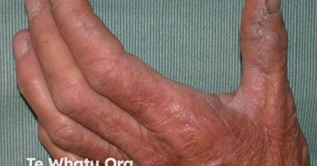 Keratoelastoidosis marginalis image