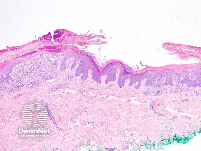 Keratosis lichenoides chronica figure 1