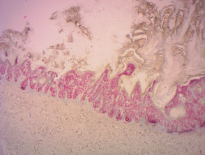 Keratotic melanoma in situ stained using SOX10 x20