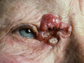 High-risk basal cell carcinoma
