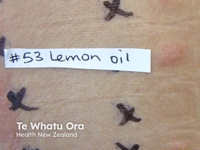Positive patch tests to lemon oil