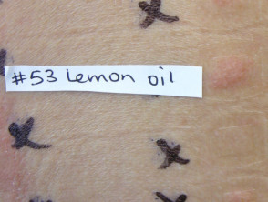 Positive patch tests to lemon oil