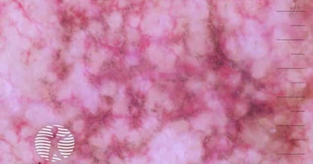 Annular granular pattern seen in lentigo maligna demoscopy image