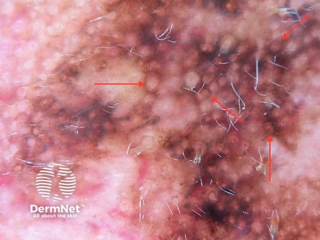 Concentric circles (red arrows) seen in dermoscopy of lentigo maligna melanoma