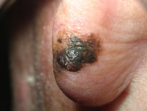 Lentigo maligna melanoma 0.98 mm