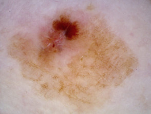Perpendicular white lines and an irregular blotch with streaking seen in dermoscopy of lentigo maligna melanoma, Breslow 0.95 mm