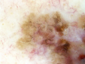 Lentigo maligna melanoma, Breslow 0.8mm