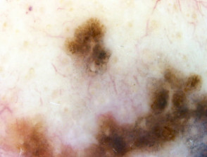 Lentigo maligna melanoma, Breslow 0.8mm