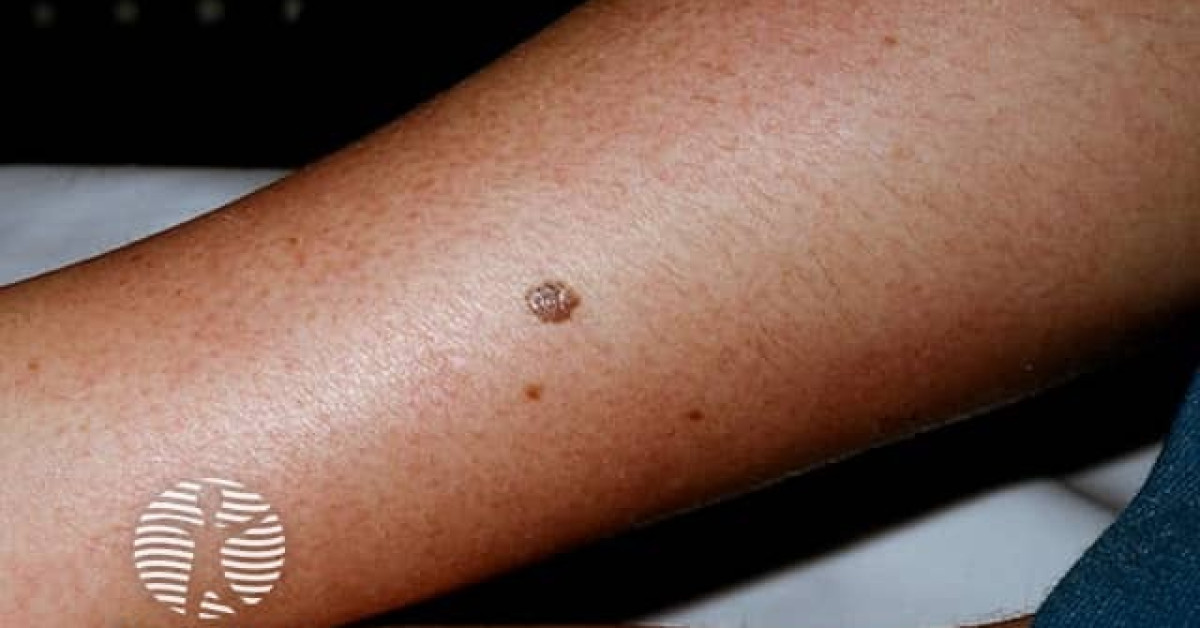 Lentigo maligna melanoma image