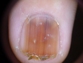Lentigo simplex of the nail