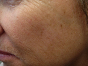 Freckle after cryotherapy