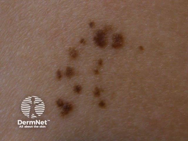 Moles melanocytic Naevi Pigmented Nevi Moles melanocytic Naevi Pigmented Nevi
