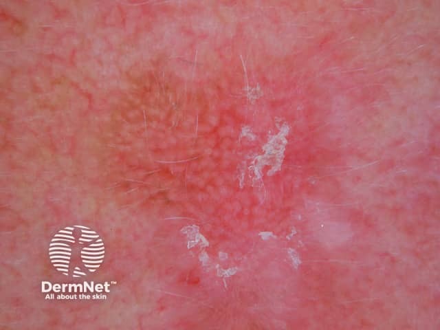 Dermoscopy of actinic keratosis on the face