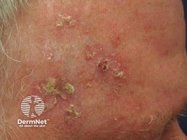Actinic Keratoses Solar Keratosis Diagnosis And Treatment DermNet Actinic Keratoses Solar Keratosis Diagnosis And Treatment DermNet