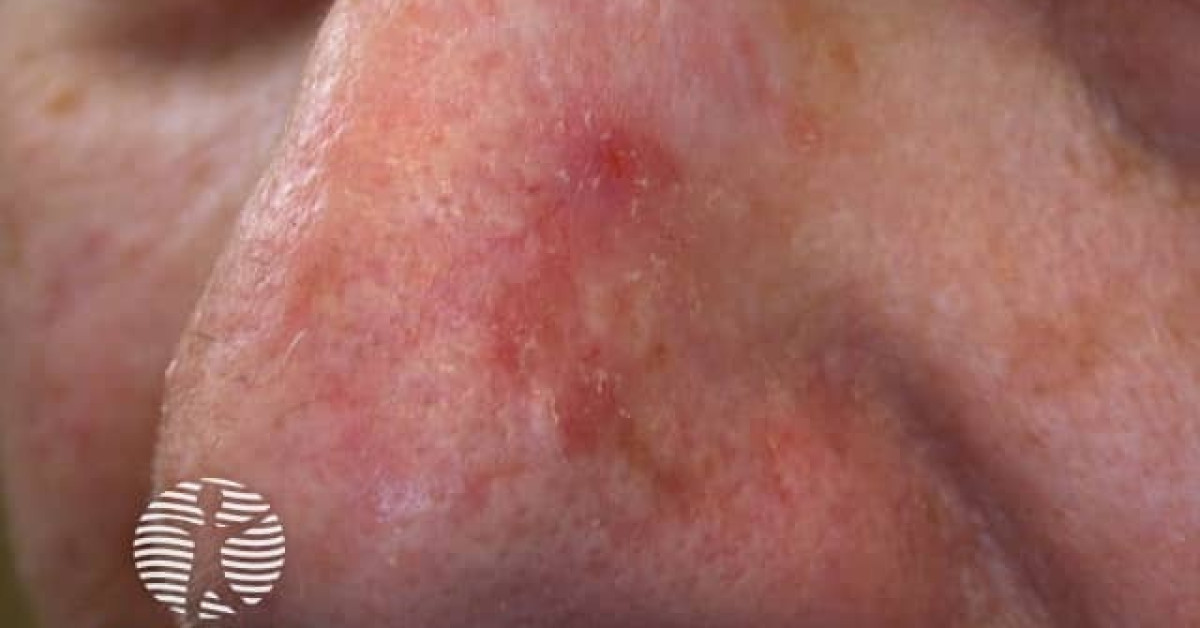 Actinic Keratoses Affecting The Face Image