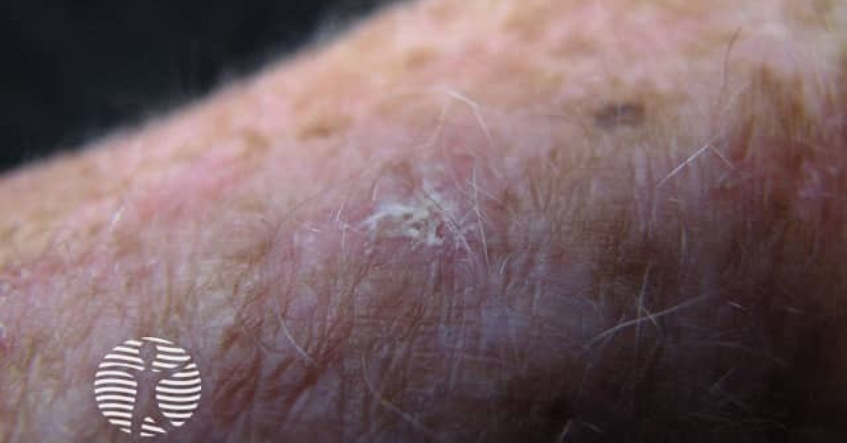 Actinic keratoses affecting the hands image
