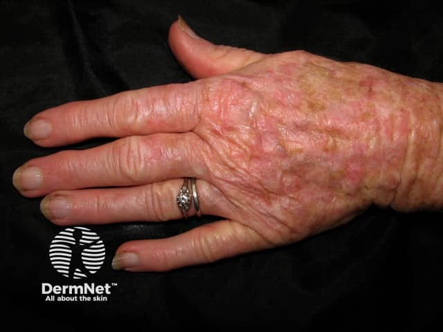Actinic keratosis affecting a hand