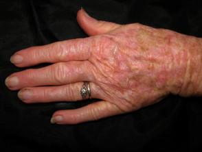 Actinic keratosis affecting a hand