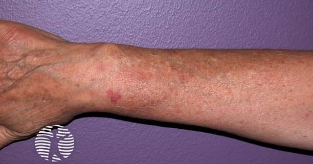 Actinic keratoses affecting the hands image