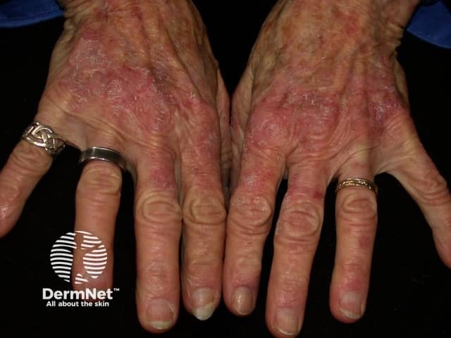 Actinic keratoses affecting the hands