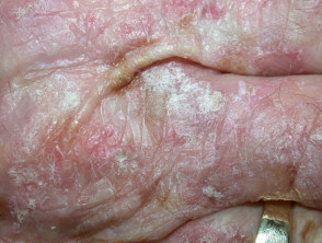 Actinic keratoses affecting the hands
