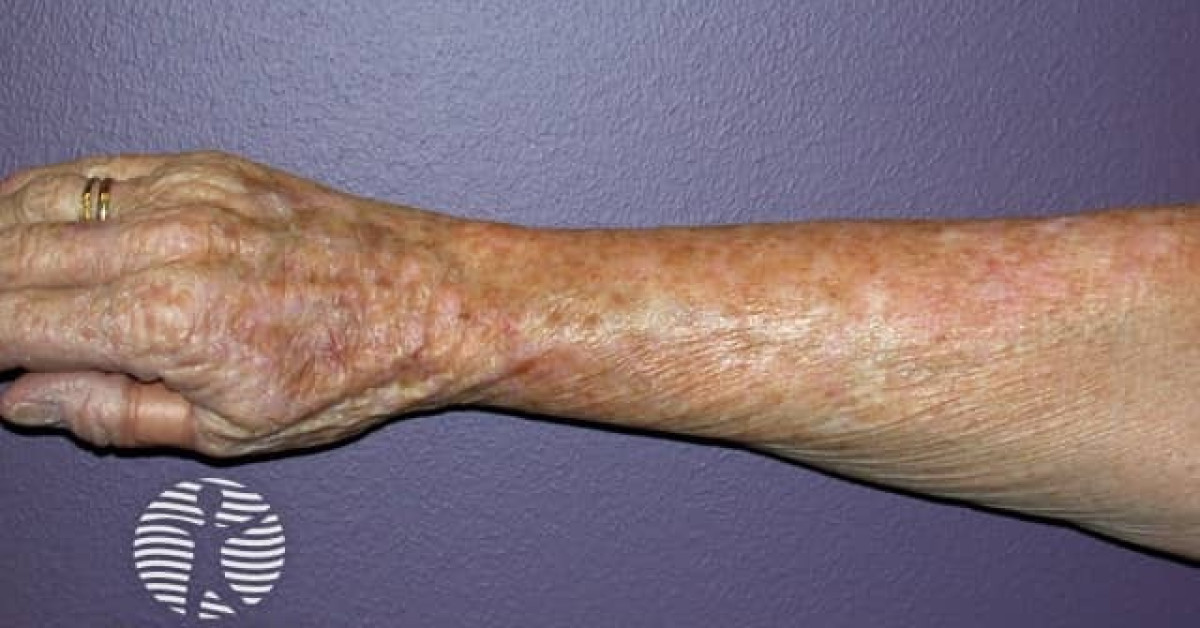 Actinic keratoses affecting the hands image