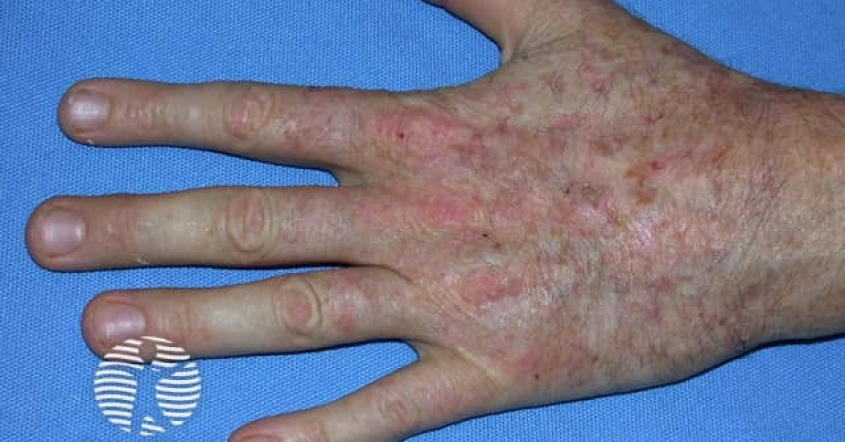 Actinic keratoses affecting the hands image