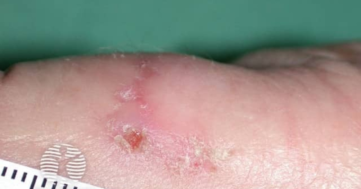 Actinic keratoses affecting the hands image