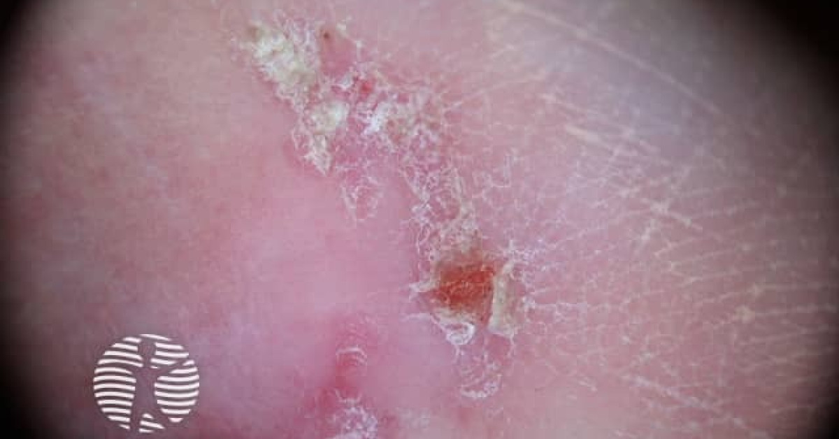 Actinic keratoses affecting the hands image