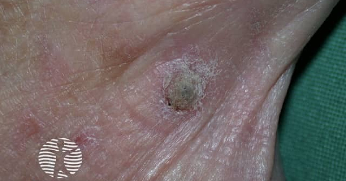 Actinic keratoses affecting the hands image