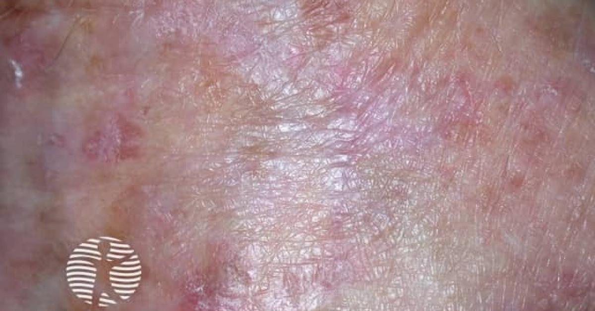 Actinic keratoses affecting the hands image