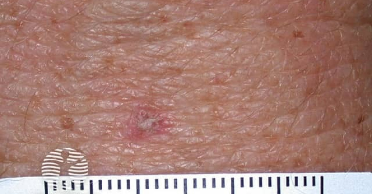 Actinic keratoses affecting the hands image