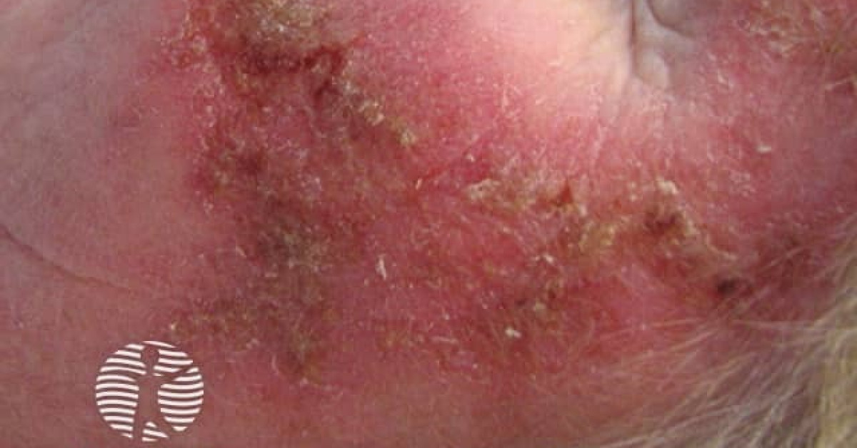 DermNet® - Actinic Keratoses treated with imiquimod image