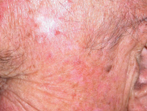Actinic keratoses treated with imiquimod images | DermNet