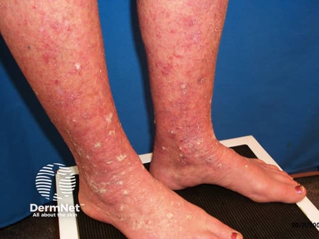Actinic keratoses affecting the legs and feet
