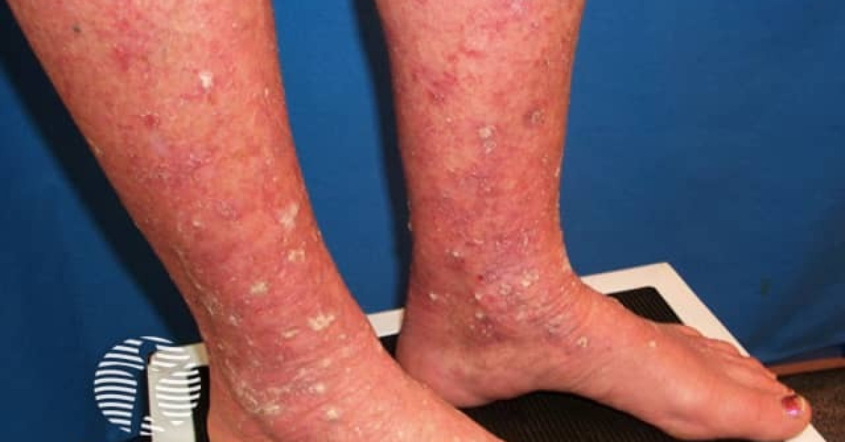 Actinic keratoses affecting the legs and feet image