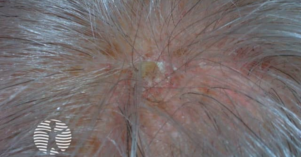 Actinic keratoses affecting the scalp image