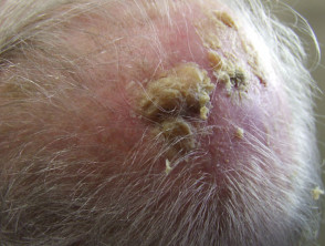 actinic keratosis on scalp