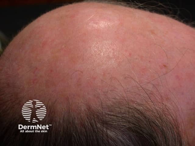 Actinic keratoses affecting the scalp
