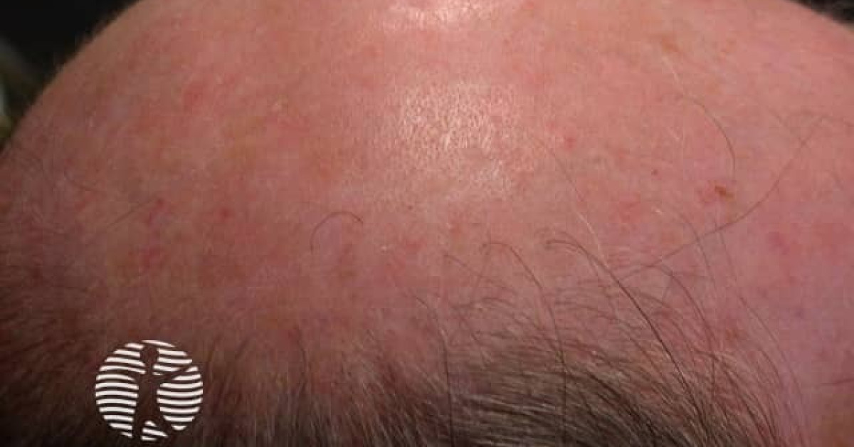 Actinic Keratoses Affecting The Scalp Image