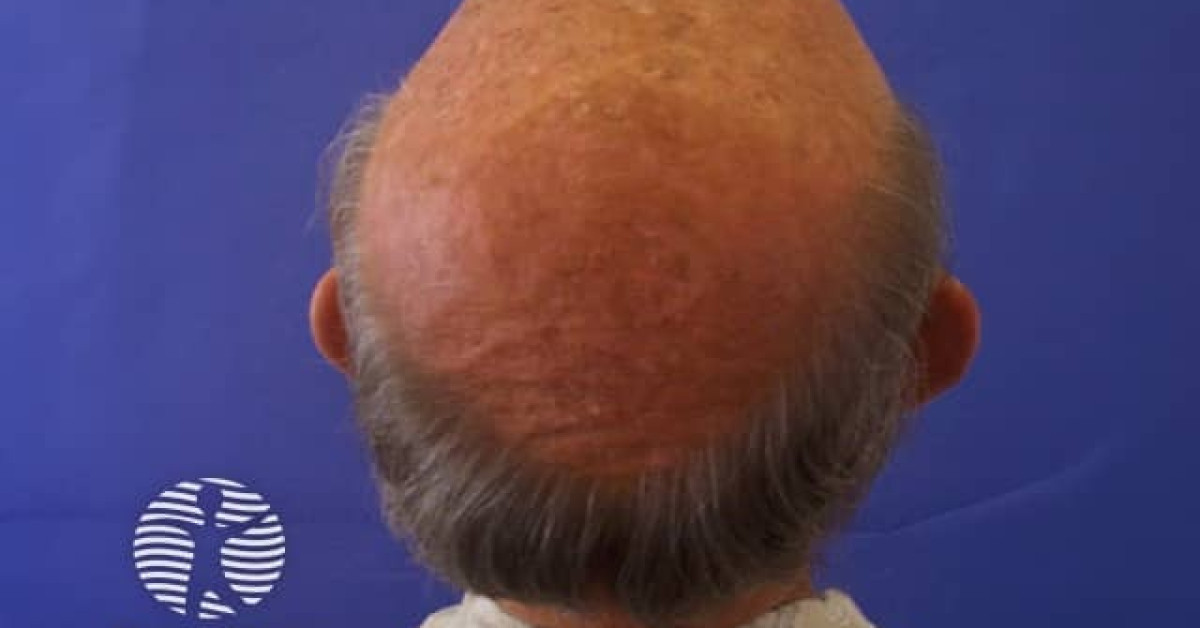 DermNet® - Actinic keratoses affecting the scalp image