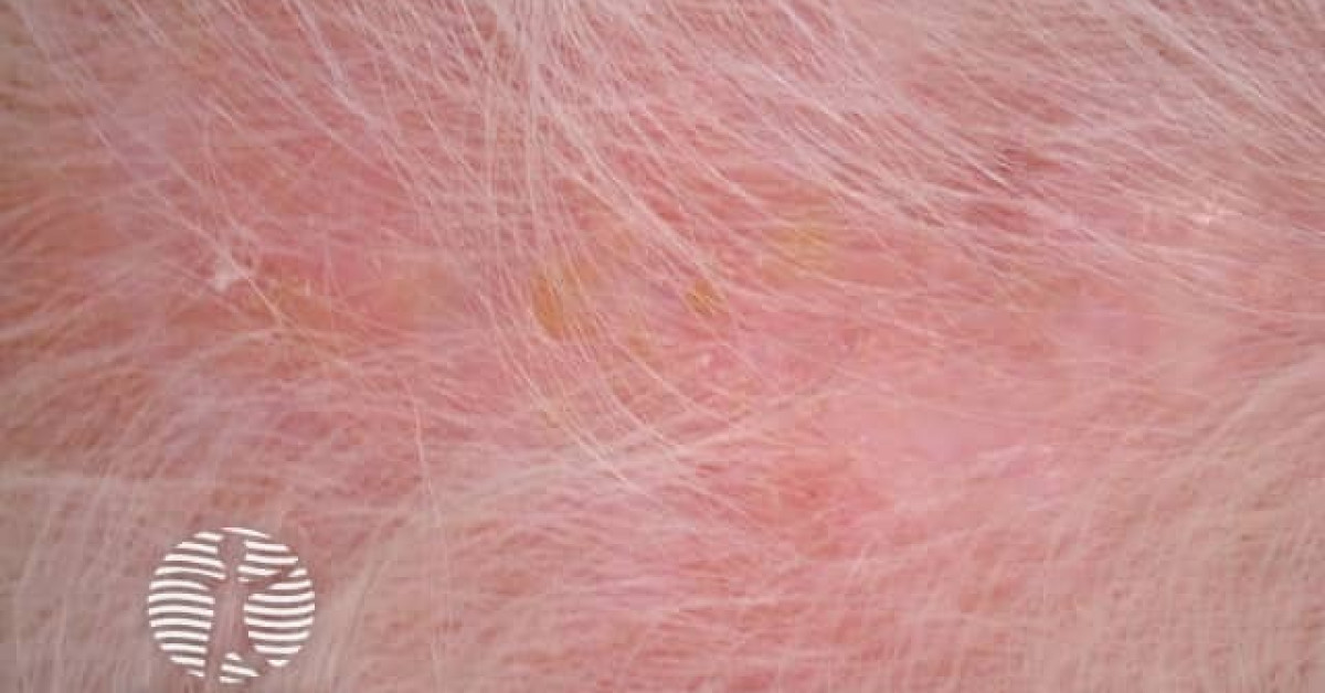 DermNet® - Actinic keratoses affecting the scalp image