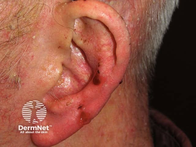 Basal cell carcinoma affecting the ear