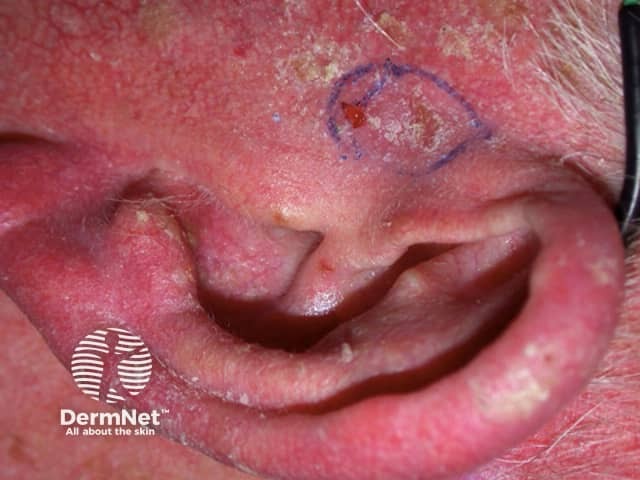 Basal cell carcinoma affecting the ear