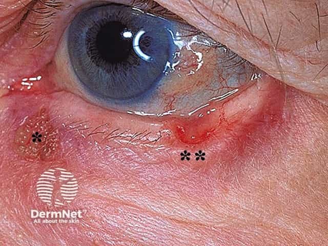 Basal cell carcinoma affecting the eyelid