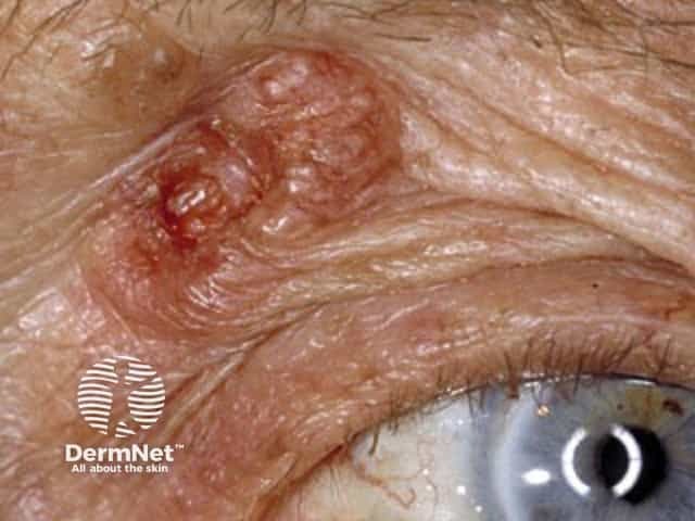 Basal cell carcinoma affecting the eyelid