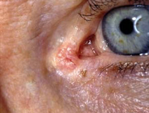 Basal Cell Carcinoma Affecting The Eyelid Images Dermnet Nz