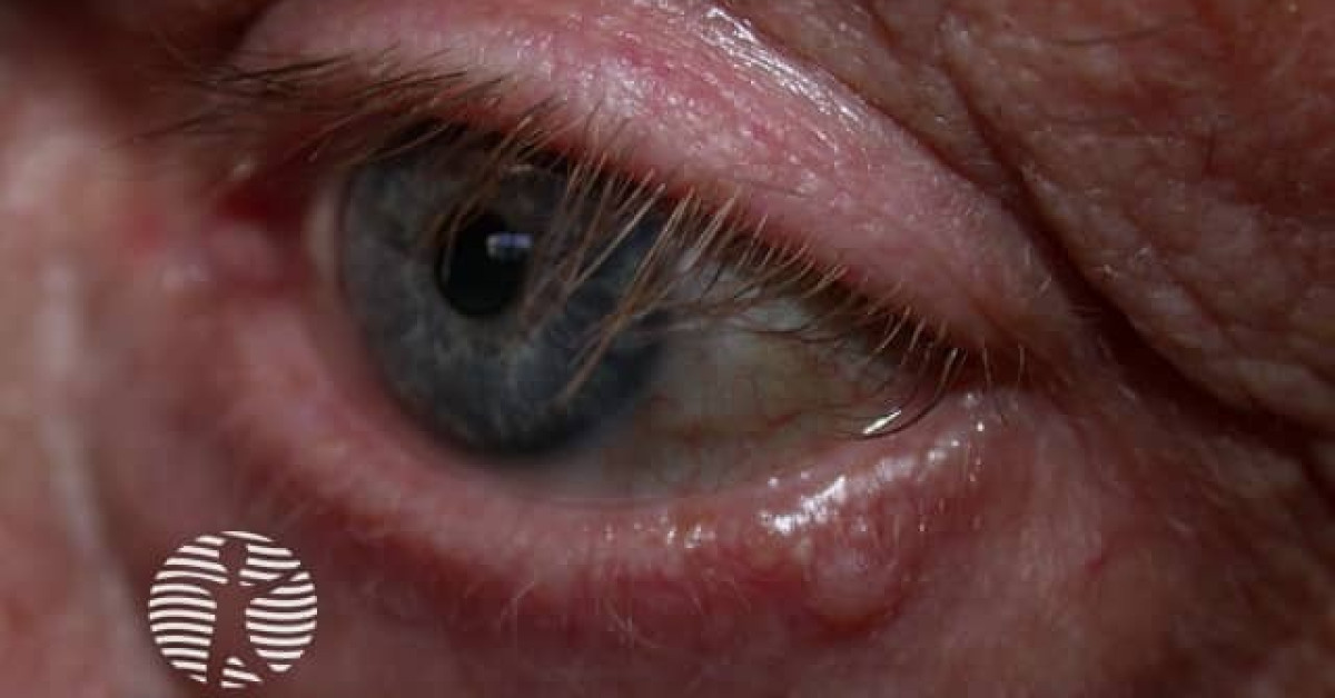Basal cell carcinoma affecting the eyelid image